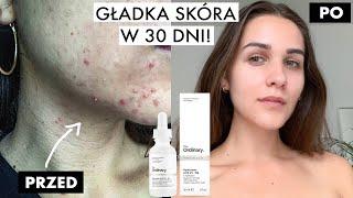 JAK POZBYŁAM SIĘ TRĄDZIKU | THE ORDINARY | GŁADKA SKÓRA W 30 DNI