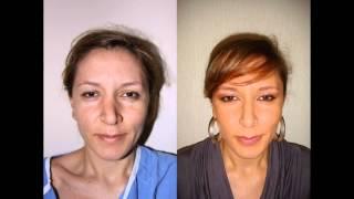 Latino & Hispanic Female Rhinoplasty NYC Before & After Dr. Sam Rizk