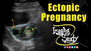 Live Ectopic Pregnancy || Ultrasound || Case 140