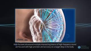 Focused Ultrasound at CES 2018: The Technology