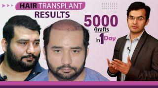 5000 Grafts Hair Transplant Results in India Before and After | Medispa India | Dr Suneet Soni