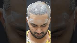 Artas Hair Transplant | Hair Transplant 10 Days Result | Hair Restoration In India