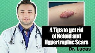 4 Tips to get rid of Keloid and Hypertrophic Scars - Dr Lucas Fustinoni Brazil