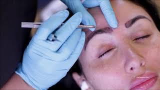 Eyebrow transplantation procedure.