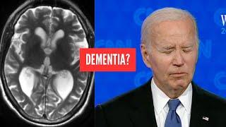 Doctor Opinion: What a doctor sees when Joe Biden hesitates - Dementia?