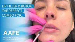 Lip Filler & Botox: The Perfect Combination for Keeping a Youthful Look