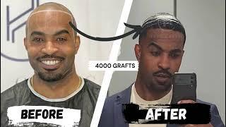 12 MONTHS 4000 GRAFTS AFRO HAIR TRANSPLANT - INSANE RESULT | HEVA #afrohair #hairtransplantturkey