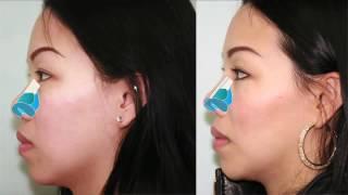 Asian Rhinoplasty Bridge Augmentation Case Study Part 3 | Dr. Buonassisi, 8 West Clinic in BC