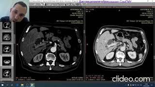 КТ органов брюшной полости. Разбор клинических случаев. Лектор Зельтер П.М.