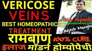 Best Homeopathic Treatment for VERICOSE Veins|Homeopathic medicines for Vericose  Veins|ehomeovision