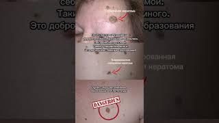 Меланома кожи.