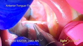 Infant Laser Frenectomy - Anterior and Posterior Tongue-Tie Releases