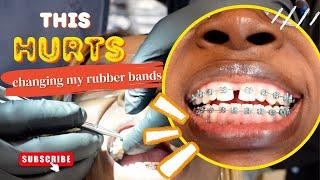 ADULT BRACES VLOG | WATCH ME GET MY RUBBERBANDS CHANGED | JUST WIDELINE