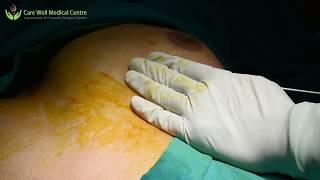 Male Breast Reduction Surgery (Gynecomastia) by Vaser Liposuction | Care Well Medical Centre