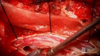 Live Surgery: Resection of Spinal Tumor - Rod J. Oskouian, M.D.