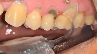 ASMR Teeth Care - Deep Cleaning of Heavy TARTAR and CALCULUS