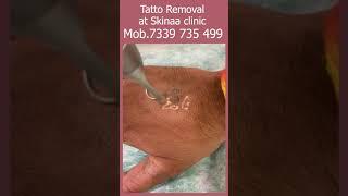 Tatto Removal at Skinaa Clinic