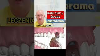 "Implant" Z Castoramy #implanty #implant #dentysta #stomatolog