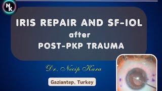 Iris Repair and Scleral Fixated IOL Implantation after Post-keratoplasty Trauma. Dr. Necip Kara