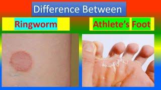 Difference Between Ringworm and Athlete"s Foot