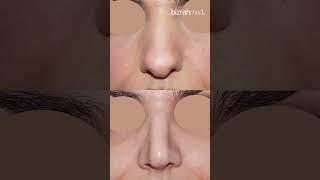 Blocked Nose & Nose Reshaping Surgery with: Dr. Bizrah/ London/Dubai