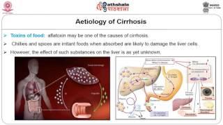 Dietary regimen in Cirrhosis and fatty liver