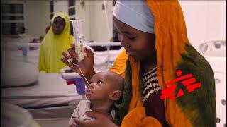 Severe malnutrition rise among children in northern Nigeria