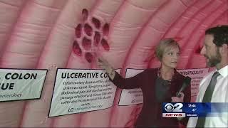 Utah Gastroenterology's Giant Colon