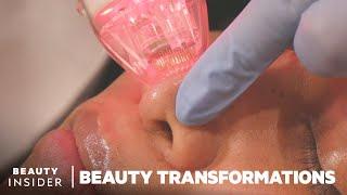 Radio-Frequency Microneedling That Is Safe For All Skin Tones | Beauty Transformations