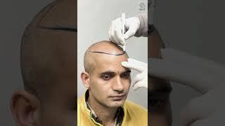 Amazing Hair Transplant Surgery | Latest Fue Technique #shorts #viral #hair transplant