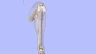 Intramedullary Nailing of the Tibia