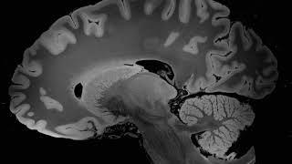 VIDEO 6 100 MICRON MRI SYNTHESIZED FLASH25 SAGITTAL