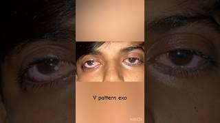 #ophthalmology #eyes #squint
