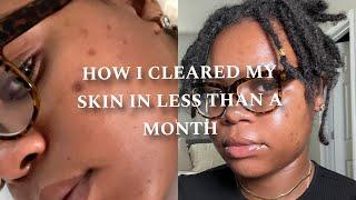 HOW I CLEARED UP MY DARK SPOTS & HYPERPIGMENTATION IN LESS THAN A MONTH! | ONLY FIVE PRODUCTS!