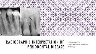 Radiographic Interpretation of Periodontal disease