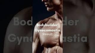 Gynecomastia Surgery| Man boobs Reduction for Bodybuilder, Poky Nipples Surat, Ankleshwar, Gujarat