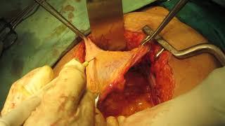 Pelvic peritonectomy for ovarian malignancy