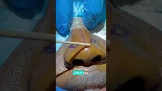 RHINOPLASTY (NOSE JOB) RESULTS - DR. TANVEER JANJUA- NEW JERSEY
