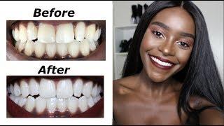 How I Whitened My Teeth At Home | Angwi Tacho