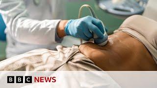 Bowel cancer rates rising among younger people | BBC News