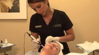 Microneedling for Skin Tightening in Connecticut at Jandali Plastic Surgery