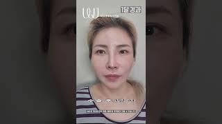 안면거상 수술전~1년 후기 #shorts