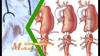 Аневризма аорты. Какие причины, симптомы и осложнения, как лечить?