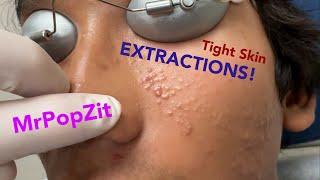 Tight skin acne extractions! Comedonal acne with some inflammatory nodules. Great session must see!