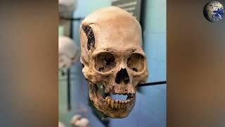 Peruvian elongated skull with a metal plate  The story.