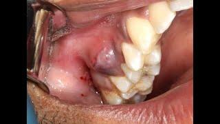 Juicy Pus Explosion from Dental Abscess with Extraction