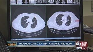 A new therapy for melanoma patients has a local tie