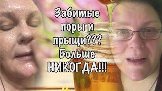  ... Забитые поры и прыщи?  Больше НИКОГДА!!!