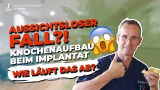 Knochenaufbau beim Implantat | Hoffnung für aussichtslose Fälle! Warum ist das so wichtig?