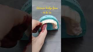 zirconia bridge from 15 to 24 # dentistry#shorts#youtubeshorts #youtube#dailyvlog#dentist